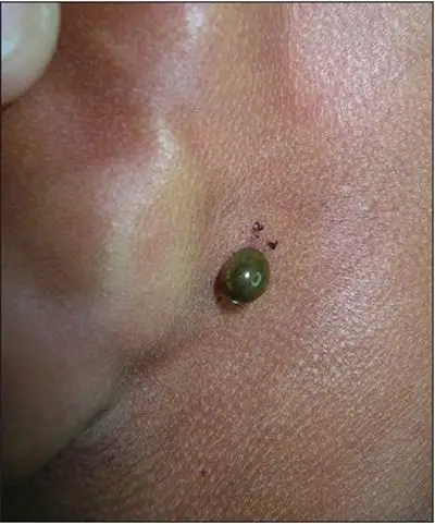 容易癌变的黑痣图片6