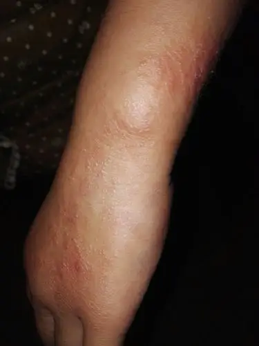 小孩胳膊起了很多疙瘩,已经很久了,去医院检查说是皮炎拿了点药膏抹了