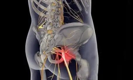 1,早期症状:疼痛多由臀部或髋部向下扩散至足部,疼痛在大腿部大转子