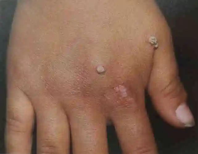 寻常疣症状_病因_治疗方法_鉴别_专家咨询|丁香医生