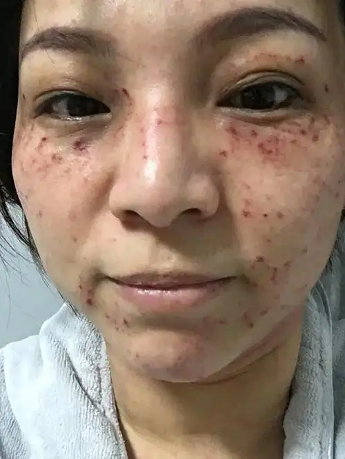 超皮秒祛斑第一天.