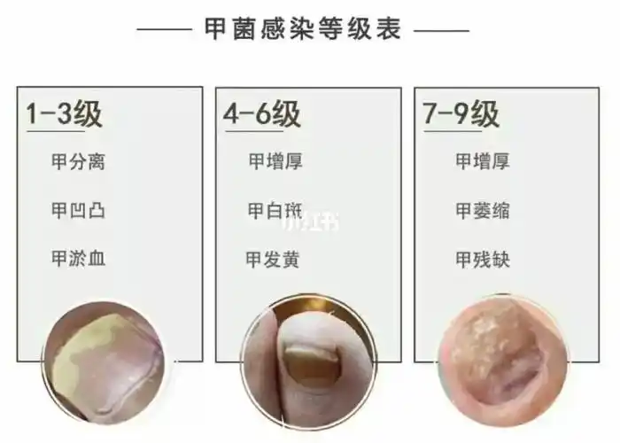 灰指甲等级区分