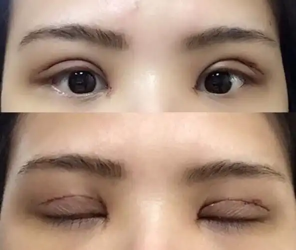 做的全切双眼皮去皮去脂案例前后对比图
