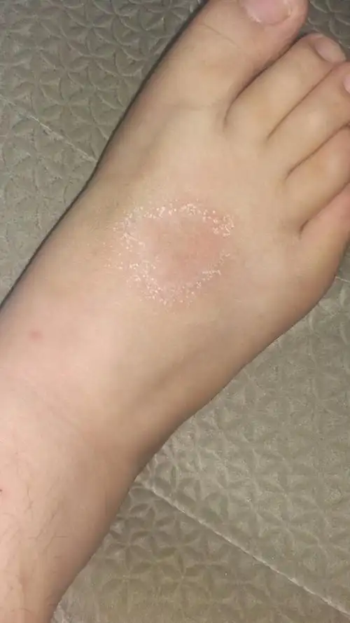 脚背上白色一圈是什么