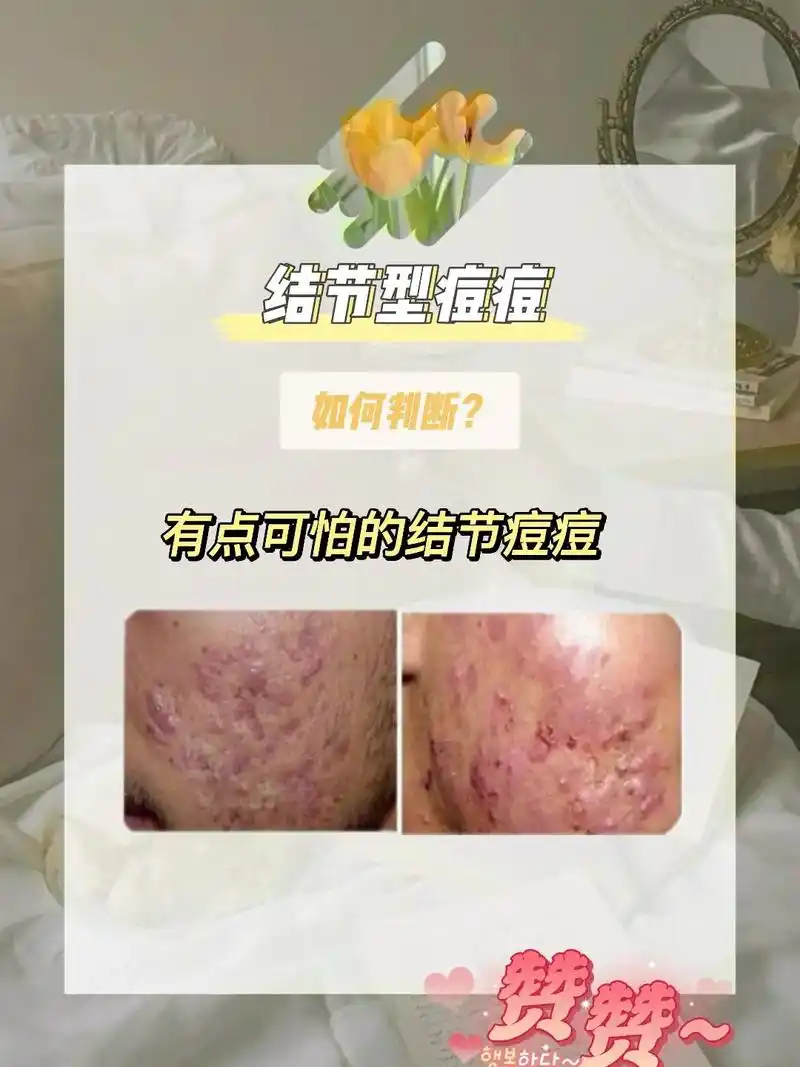 结节型痘痘是由于粉刺,丘疹或脓包护理不当所 - 抖音