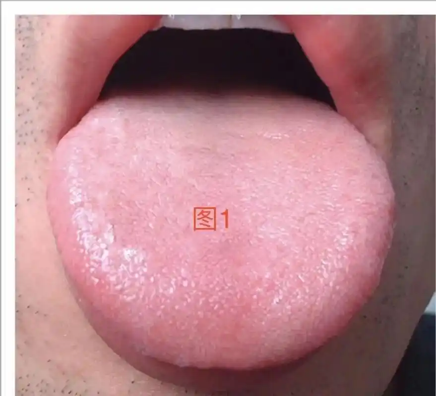 常见舌苔照片, 图1:正常舌象,淡红色,薄白苔 图2:舌边齿 - 抖音