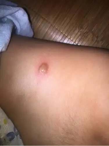 有谁知道宝宝身上这长的是什么?在后背腰上