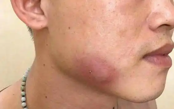 男子脸上长出一个包去医院检查后结果让人意外因为人人都有