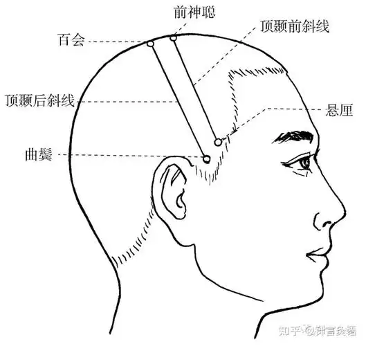 中风系列│头针疗法治疗中风 - 知乎