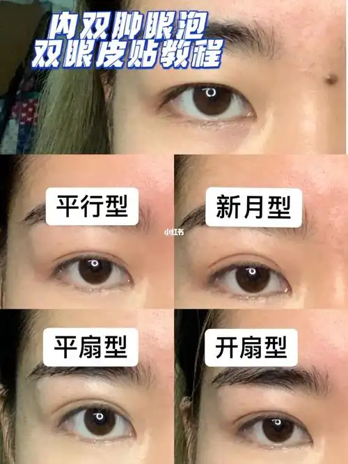 内双肿眼泡双眼皮贴实用教程