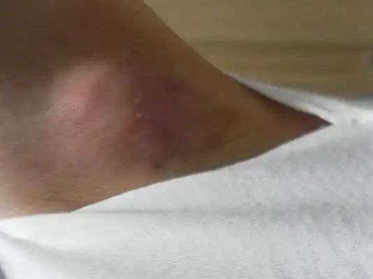 武汉淋巴结肿大专家_武汉治疗淋巴结肿大哪个专家好_武汉治疗淋巴结