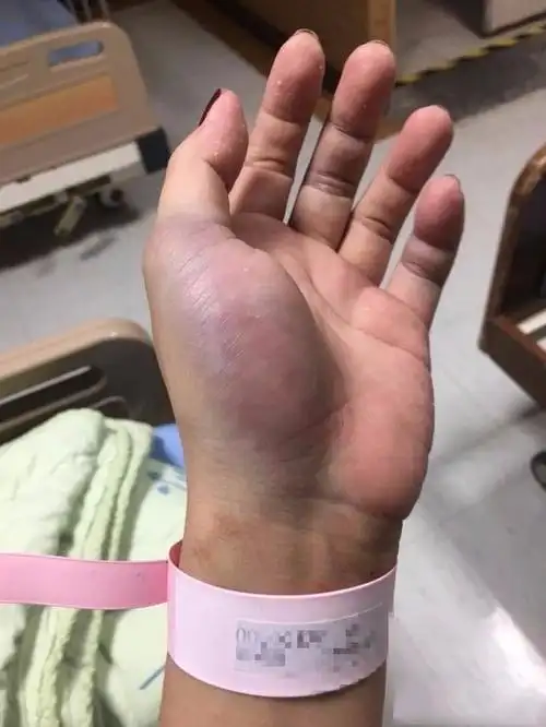 只为了和老公拿小孩护照,分居老公和弟弟居然联手「狠打老婆」到吐血!