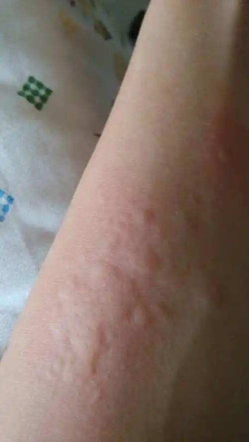 前天晚上身上开始发痒 昨天背上就起红斑了 今天早上