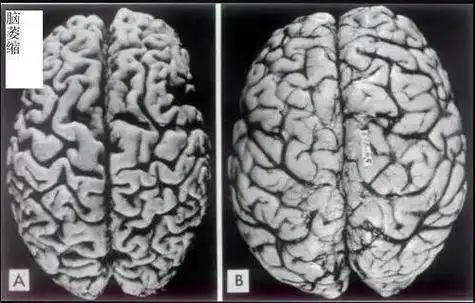 正常端脑    可以看到,酒精依赖患者的左,右大脑的灰质体积与健康对照