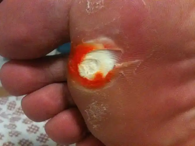 贴了鸡眼膏四盒后,每天都换药,变成这样了,算是好了吗,不疼了