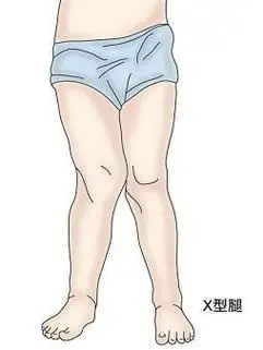 怎么判断膝关节错位膝外翻或膝内翻到底是什么该怎么办呢