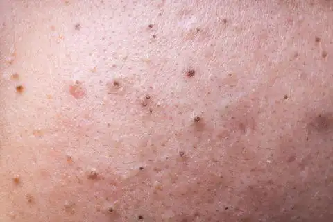 脸上黑头总是挤不完千万要记住这5点超级重要