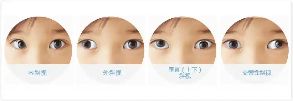 斜视三,会导致颈部发育畸形临床上有一种斜视叫麻痹性斜视,这种斜视的