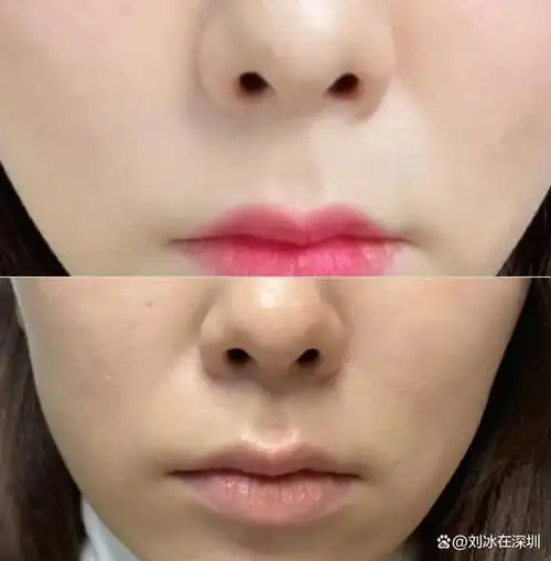 鼻基底凹陷和法令纹有什么区别呢