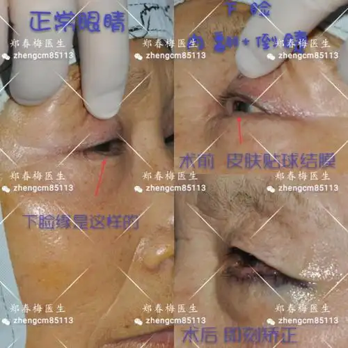 下眼睑内翻倒睫