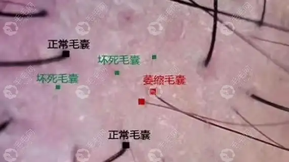 毛囊检测直接看毛囊是否萎缩闭合