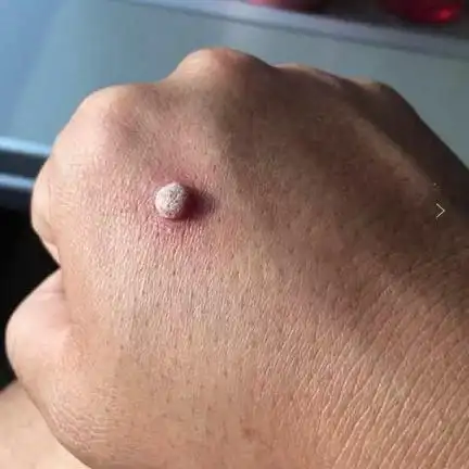 长了瘊子一个方法就搞定管用少花钱σ