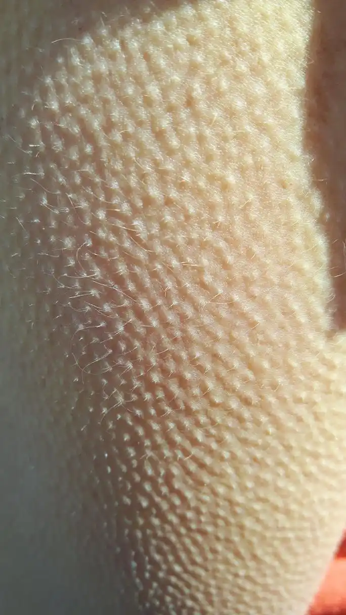 鸡皮肤,也称为角质过度增生,是指皮肤表面出现粗糙,颗粒状的小推痧