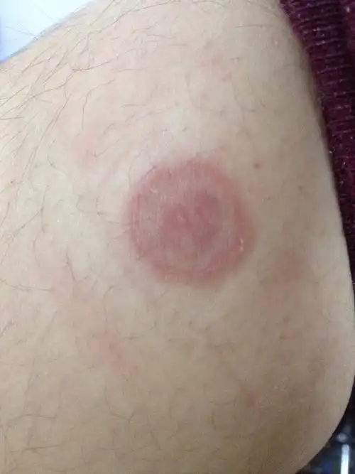 小腿上起了一片红色的圆圈状懂得东西,很痒