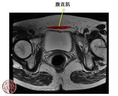 医学笔记|一起读盆腔核磁共振:经女性股骨头韧带的横断层_解剖