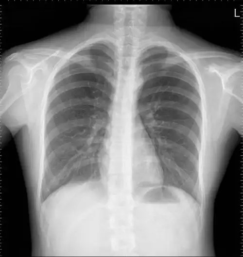 翻到去年查肺结核的胸片发现我好像真的脊椎侧弯啊