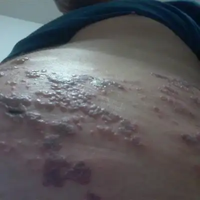 缠身龙是什么症状图片