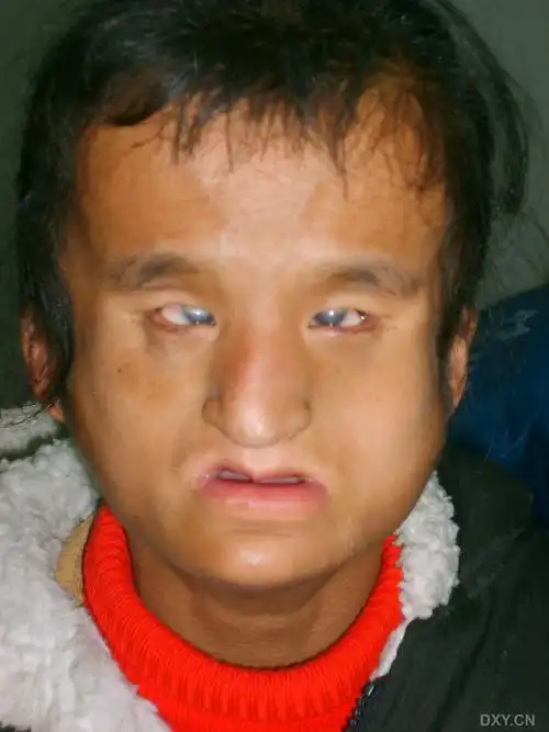 【角膜病讨论】是否"鸟面综合征"? [精华]