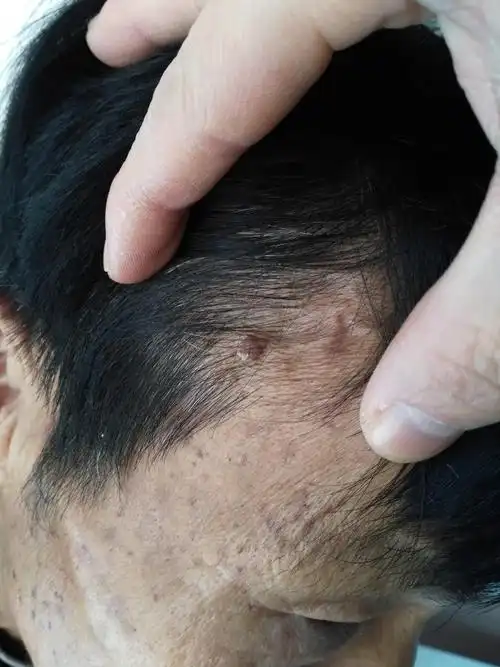 发现头皮疣状物半年