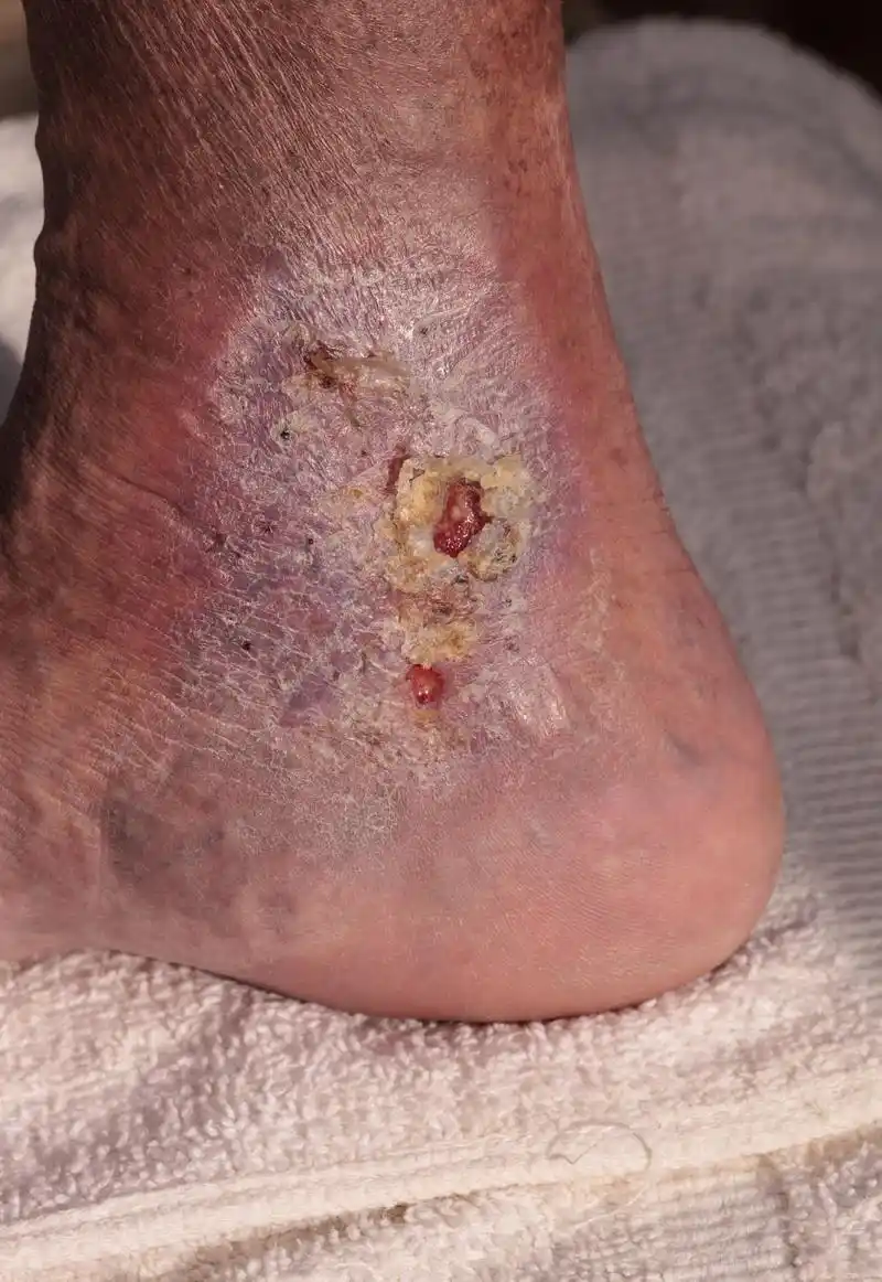 一年前,她的左脚开始出现隐痛,随着时间的推移,这种