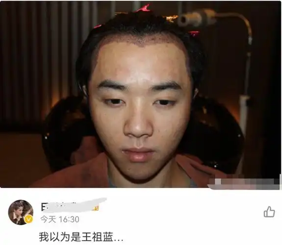华晨宇被网友爆料整容,晒出植发照,网友吐槽太丑意外撞脸王祖蓝
