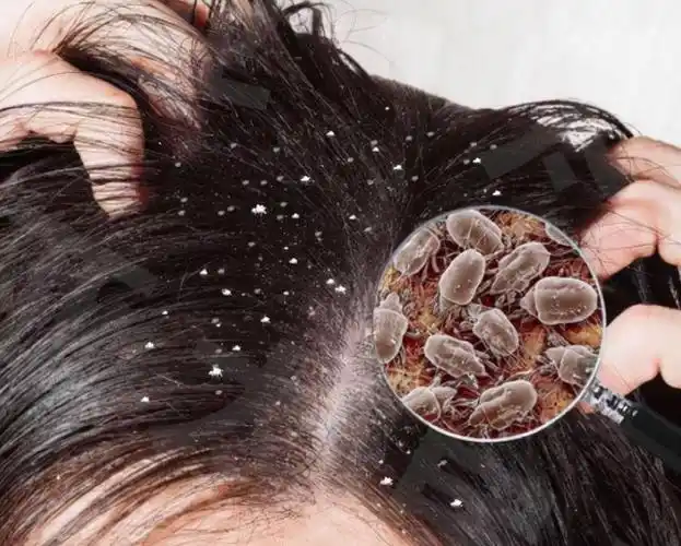 一年不洗头会发生什么?