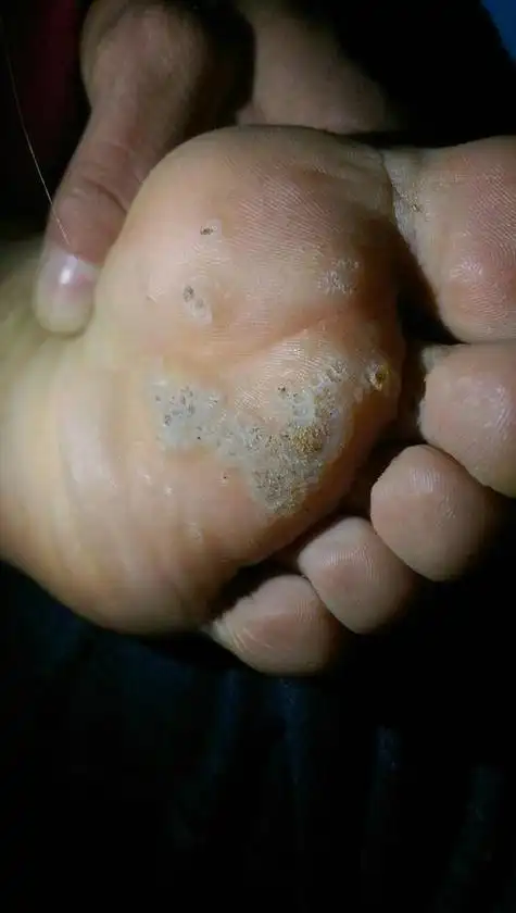 鸡眼图片初期症状 鸡眼早期症状图片