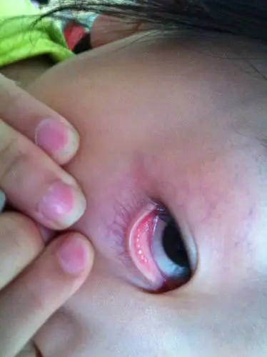 问:眼睛里面有白色的小颗粒.不痛不痒.