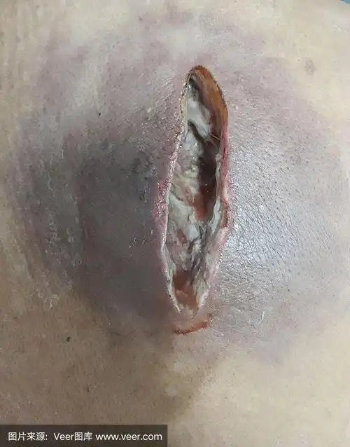 手术伤口有大脓肿,周围有蜂窝织炎.