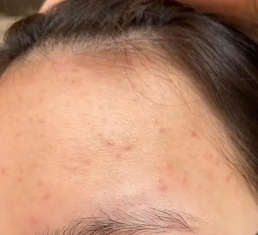 女士额头长痘痘是怎么造成的,女性额头长痘痘