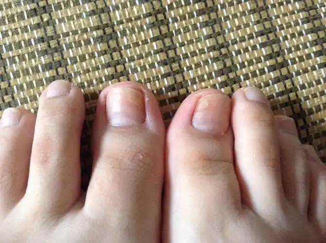 我的两个脚大拇指指甲外缘前面变黄感觉那一块比旁边的指甲要厚