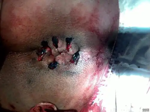 做痔疮手术后出现水肿怎么办?