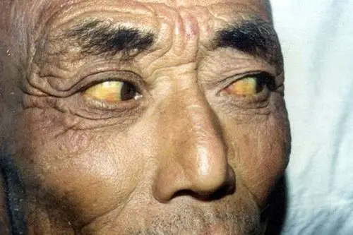 肝病面容]面色红黄阳黄图片