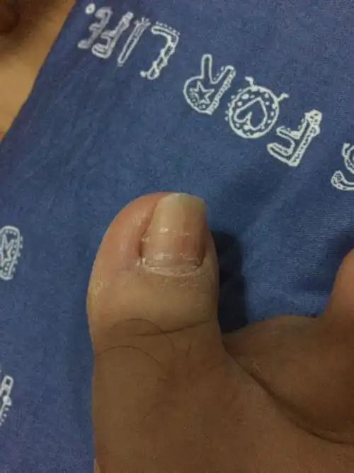 脚大拇指指甲有横纹,横纹处有凹陷,请问是灰指甲吗?严重吗?