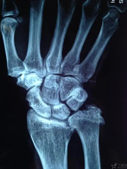 尺骨茎突不明增生···尺骨茎突撞击综合征?