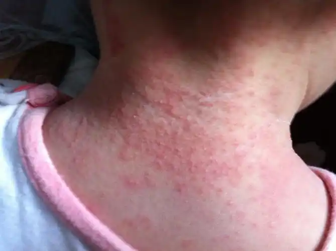 一岁的宝宝后脖子处,两天前长出来的.请问这个是热痱子吗?