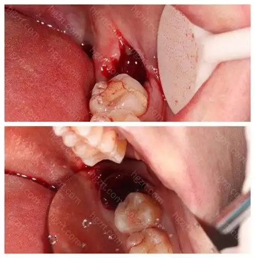 拔智齿后那个洞臭到恶心?看拔牙后窟窿恢复图了解原因 _韩国整容通