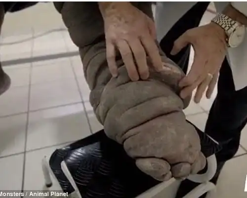 柬埔寨男子20年前染上寄生虫现左腿极度肿胀如小猪