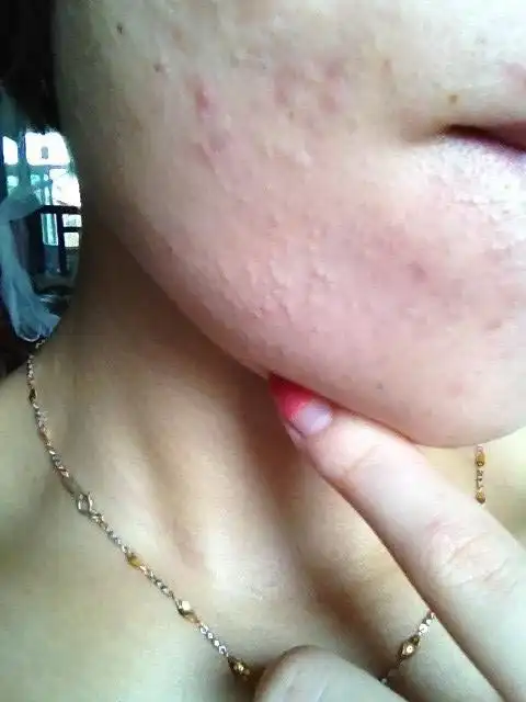 痘痘困扰,毛孔堵塞问题