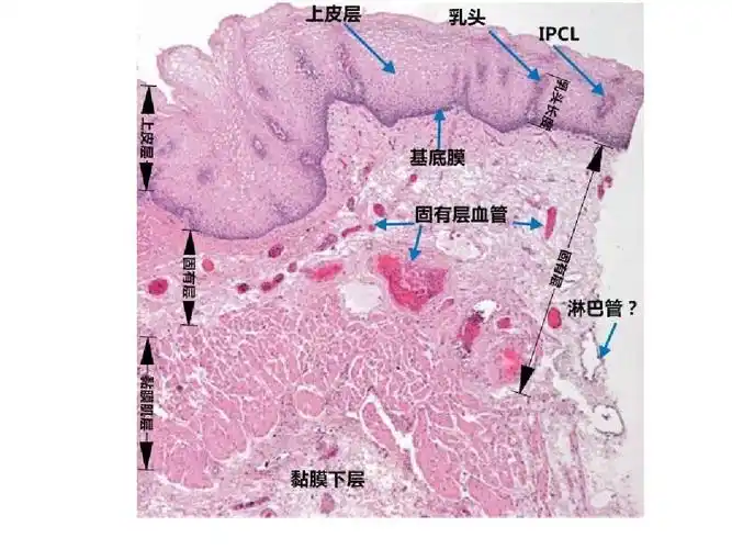 早期食管病变串讲0926